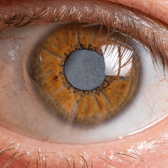 Understanding and Treating Posterior Capsular Opacification after