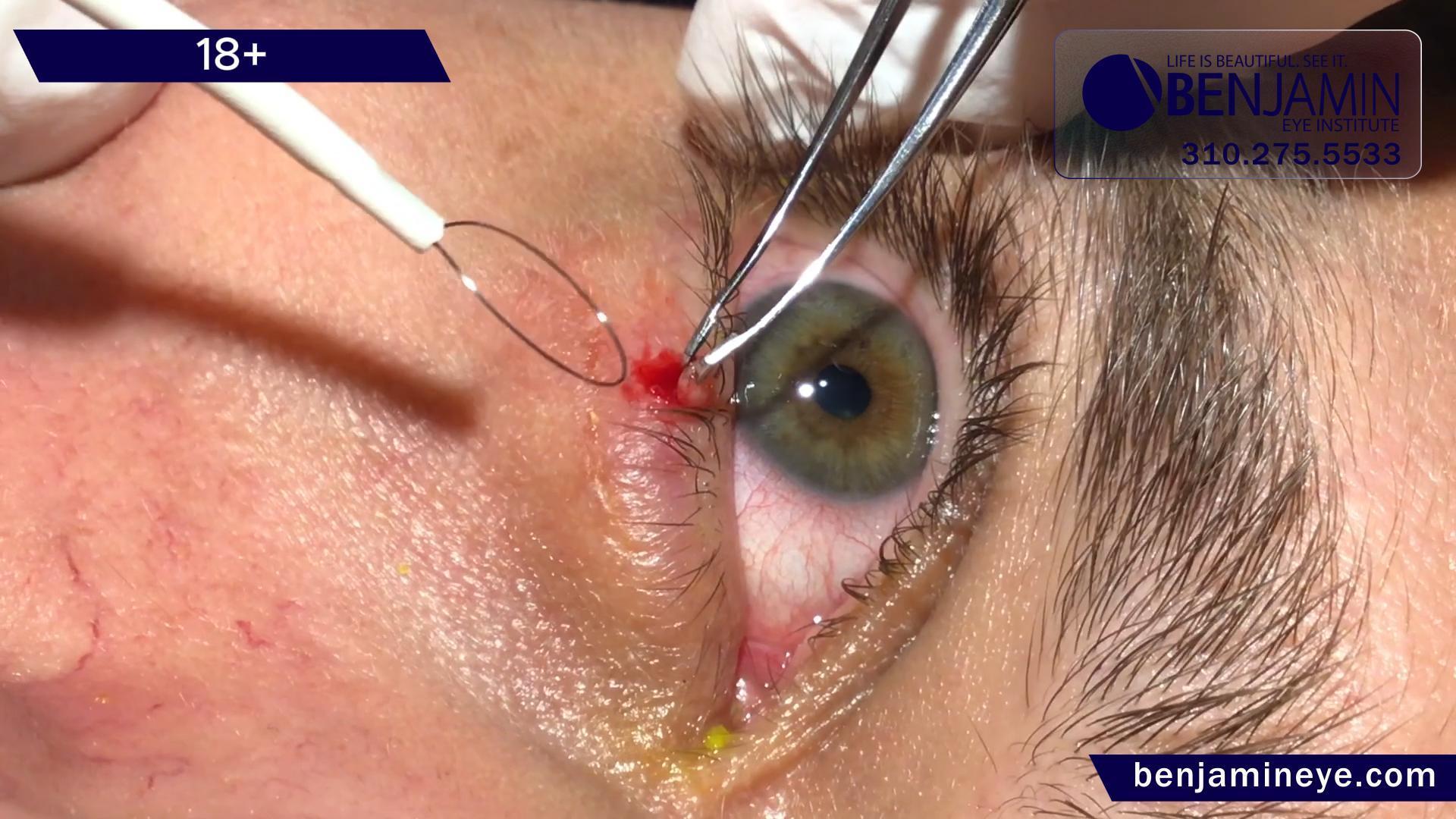Masterful Precision: Dr. Benjamin's Approach to Cystic Eyelid Lesion Removal